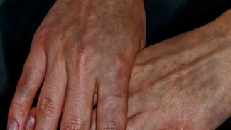 Врач-дерматовенеролог А. Макарова рассказала о возникновении "Холодовой аллергии"