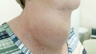 Самарские врачи провели провели сложнейшую операцию по удалению килограммового зоба у 72-летней пациентки