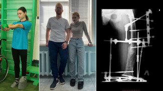 В Самаре спасли от ампутации 15-летнюю девочку с ногами разной длины