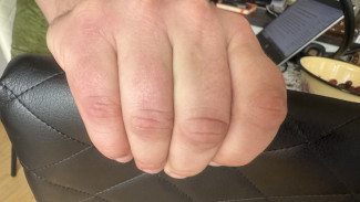 Нехороший симптом: самарцам рассказали, к чему холодеют пальцы 