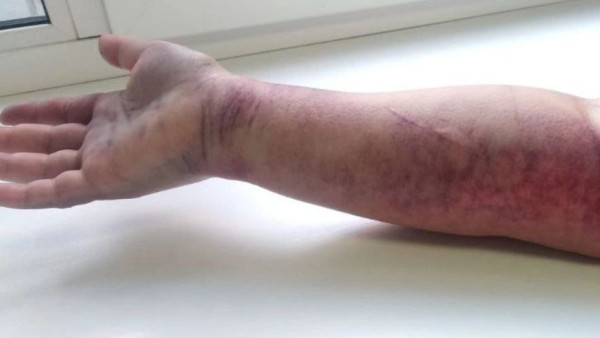 В Самарской области женщина перепутала шланг с гадюкой и едва не погибла 