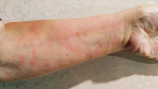 Самарцам рассказали, с каким цветом кожи нужно срочно бежать к врачу