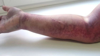 В Самарской области женщина перепутала шланг с гадюкой и едва не погибла 