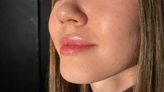 Дерматолог Егорова объяснила, почему появляется «синдром талого снега» у самарцев