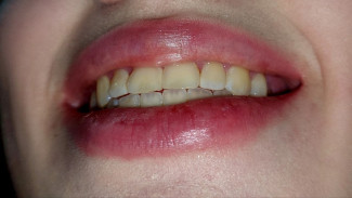 Врачи предупредили самарских пациентов о предраковом смертоносном состоянии