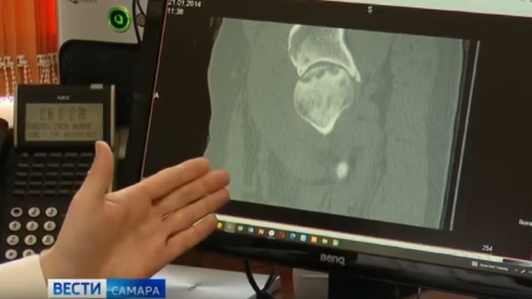 Жителям Самарской области рассказали о современном методе лечения остеоартроза