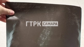 Спина из металла: в Самаре пациентка узнала о страшном диагнозе