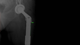 Самарские ученые создали первый российский раздвижной эндопротез тазобедренного сустава