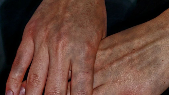 Врач-дерматовенеролог А. Макарова рассказала о возникновении "Холодовой аллергии"